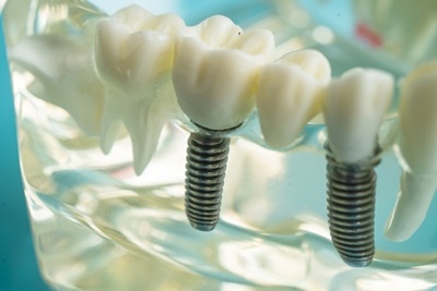Close up of a dental implant model with two threaded posts and attached crowns. Teeth are shown inside a clear jaw form.